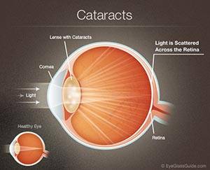 cataract illustration